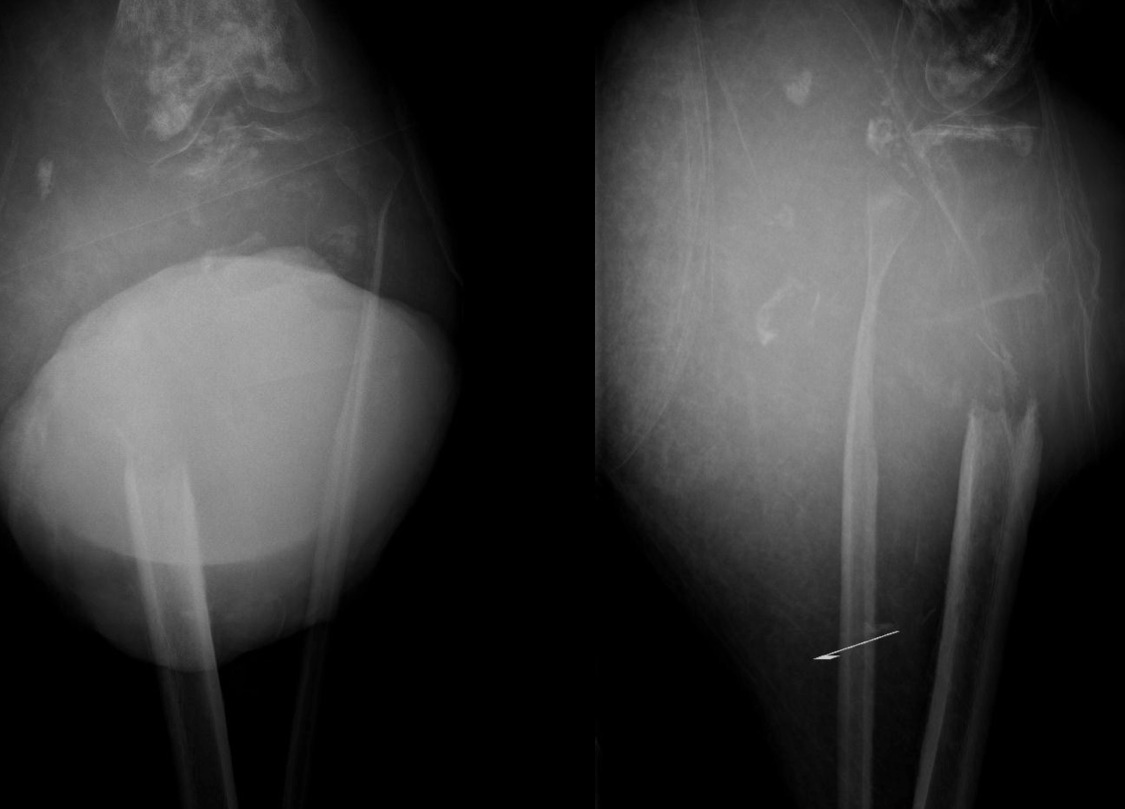 Figure 6 for case Dedifferentiated liposarcoma ( RID4360 )